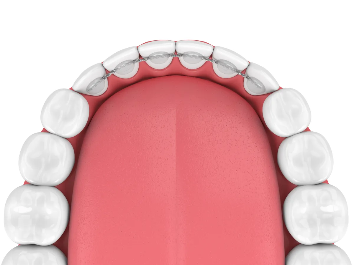 A patient with lingual braces smiling naturally