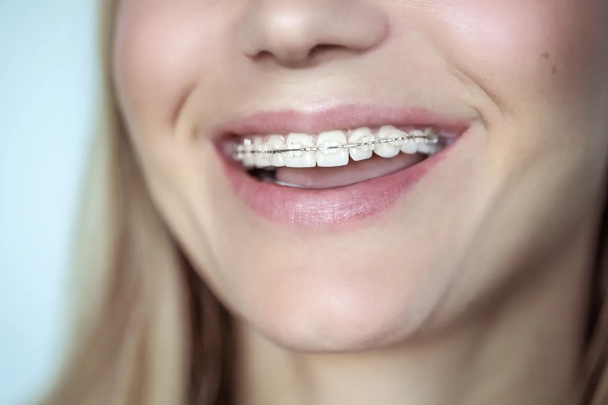 A confident patient mid-treatment with ceramic braces