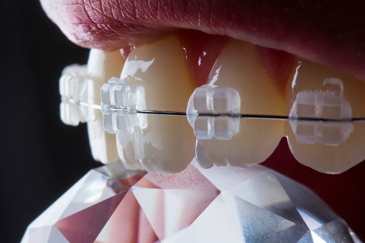 Ceramic Braces
