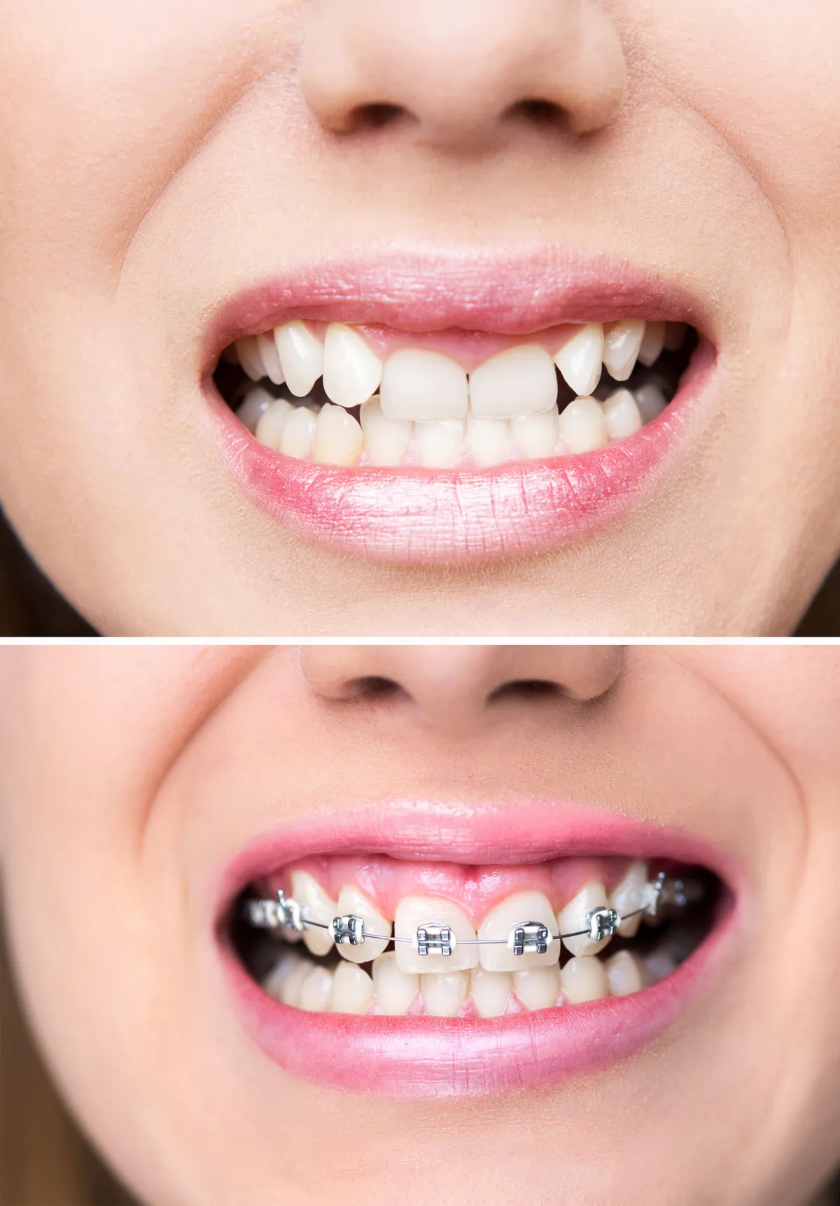 A patient with a close-up of metal braces on their teeth