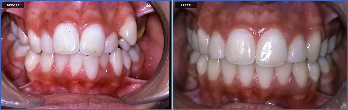 Ceramic braces before and after - case 1