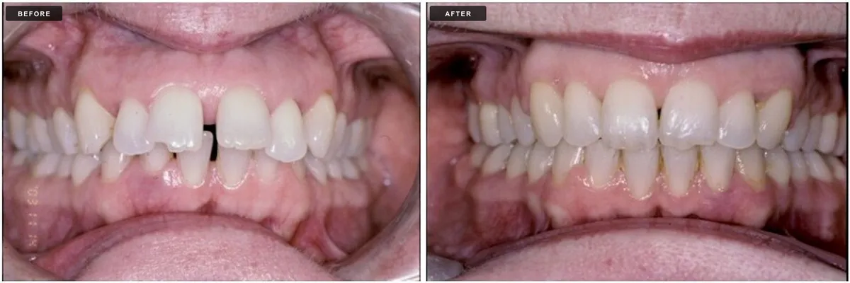 Ceramic braces before and after - case 2