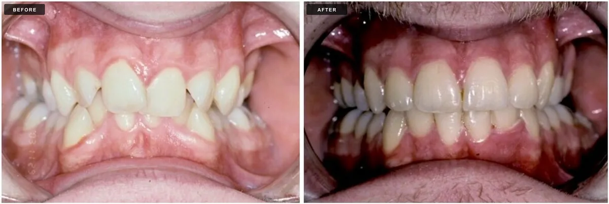 Ceramic braces before and after - case 3