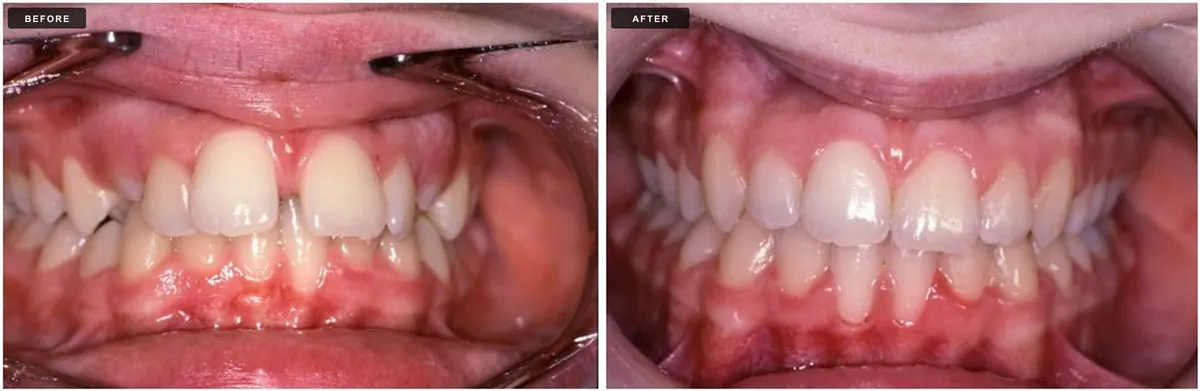 Ceramic braces before and after - case 4