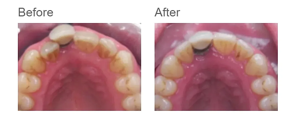Invisalign before and after - case 1