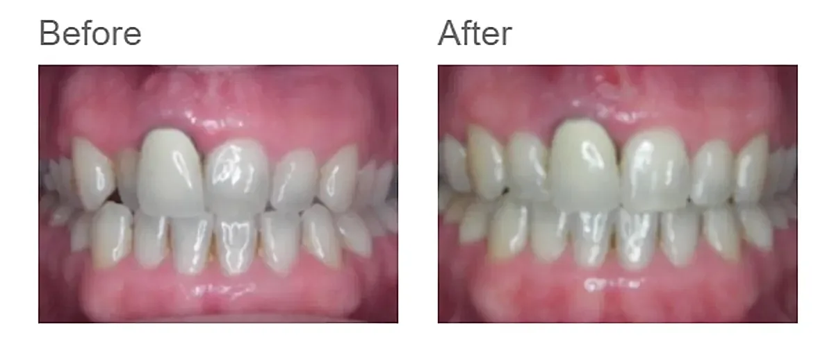 Invisalign before and after - case 2
