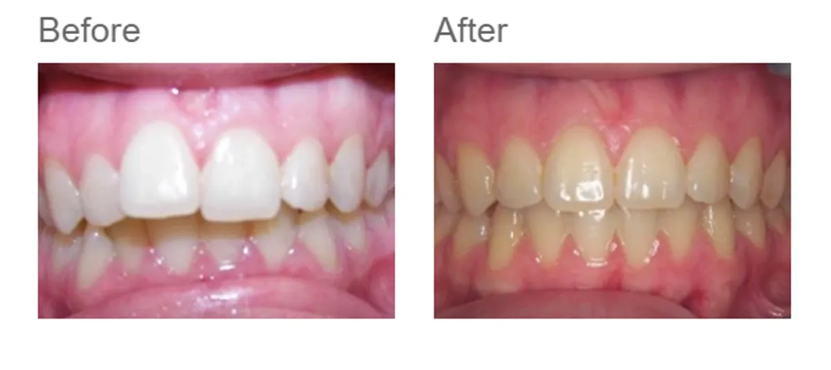 Invisalign before and after - case 4