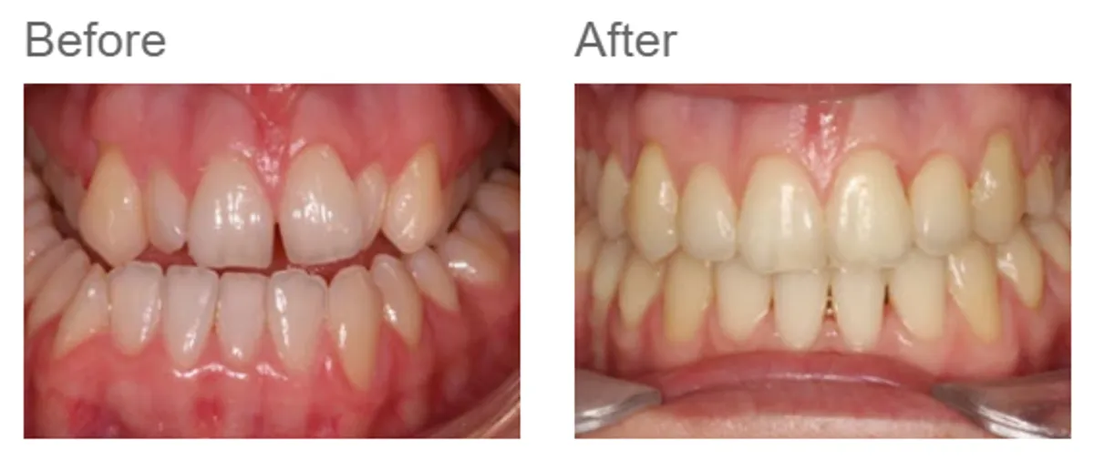 Combined orthodontic and jaw surgery - case 1