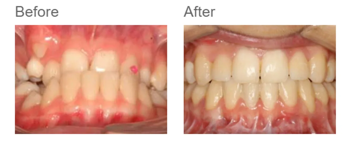 Combined orthodontic and jaw surgery - case 2