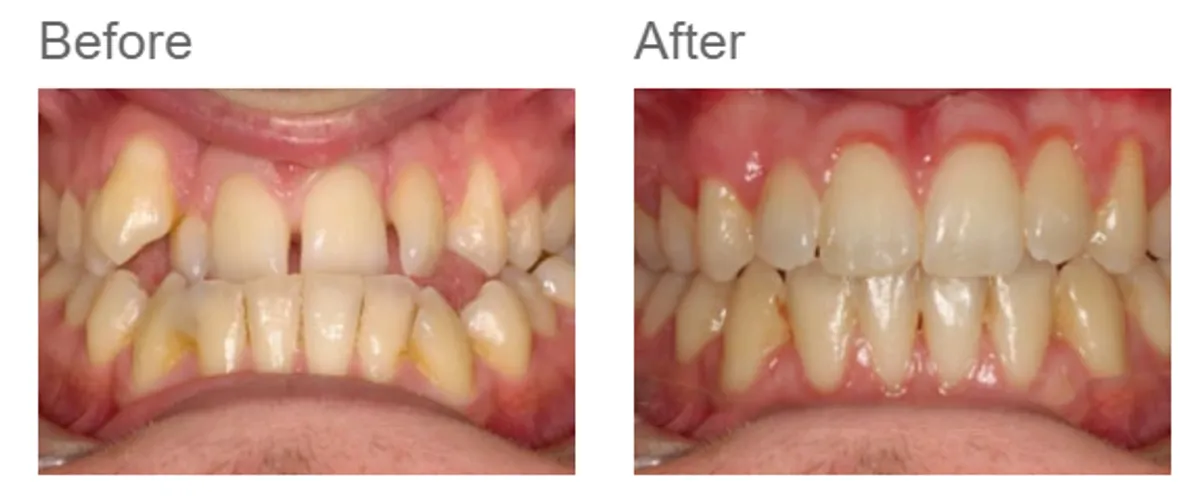 Combined orthodontic and jaw surgery - case 3