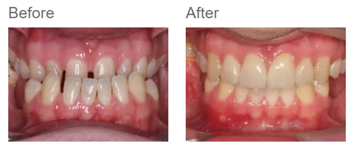 Combined orthodontic and jaw surgery - case 4