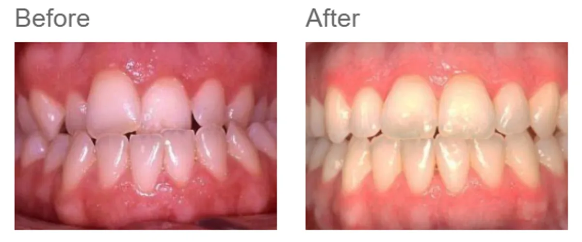 Combined orthodontic and jaw surgery - case 5