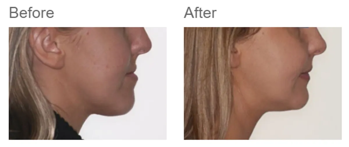 Combined orthodontic and jaw surgery - case 6
