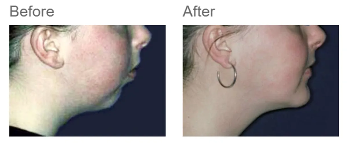 Combined orthodontic and jaw surgery - case 7