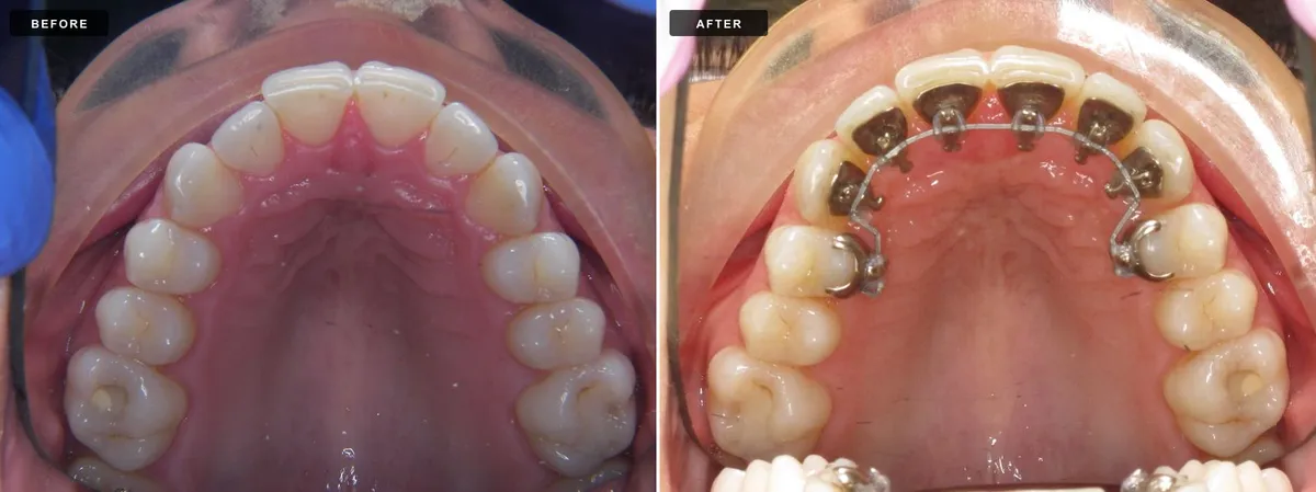 Lingual braces before and after - case 1