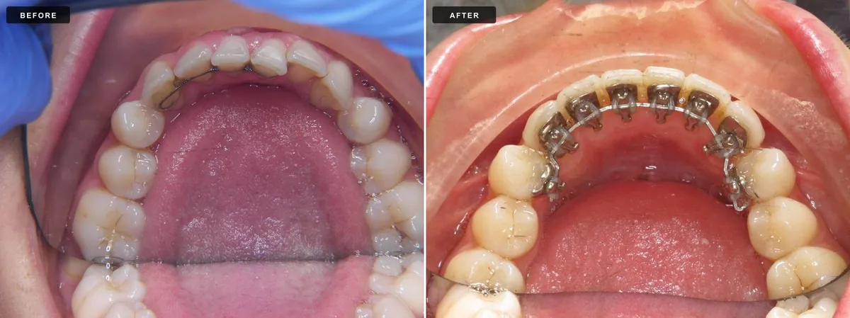 Lingual braces before and after - case 2