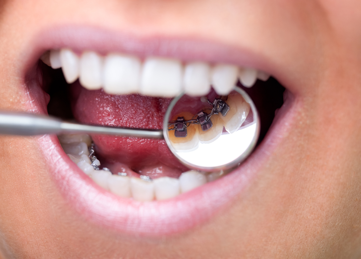 Are Lingual Braces Invisible?